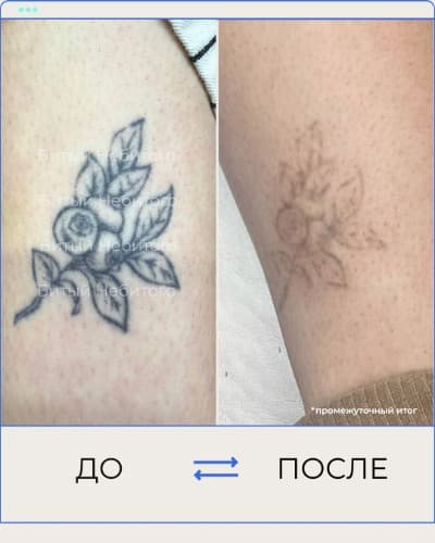 Удаление татуировки